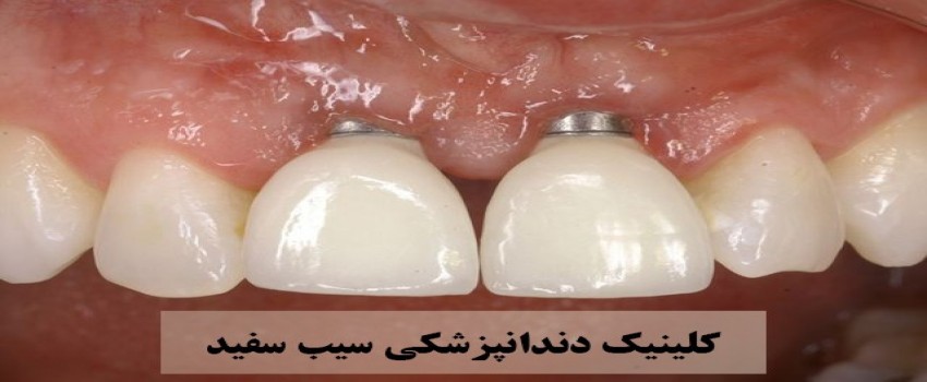 علت لق شدن ایمپلنت دندان